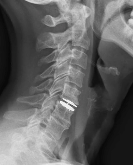 disc replacement surgery