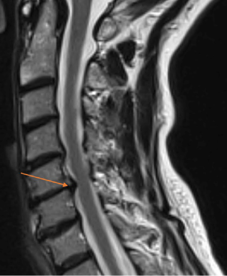 ruptured disc in neck